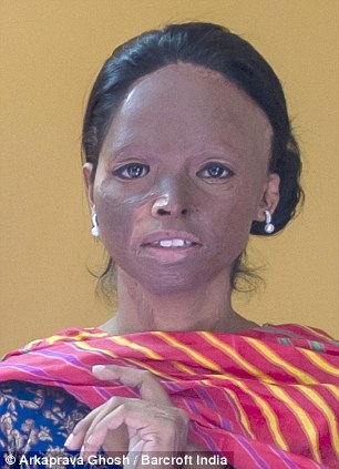 After Acid Attack